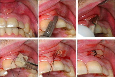 How to get rid of toothache pain with natural home remedies