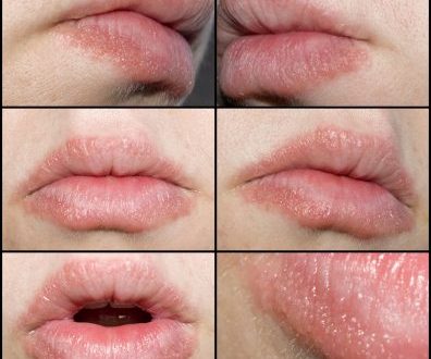 How to treat cracked or dry lips with homemade scrubs