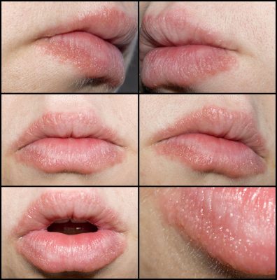 How to treat cracked or dry lips with homemade scrubs