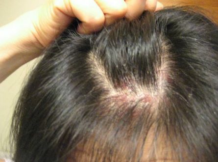 How to treat scalp acne with home remedies