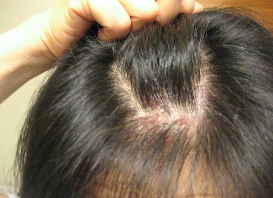 How to treat scalp acne with home remedies
