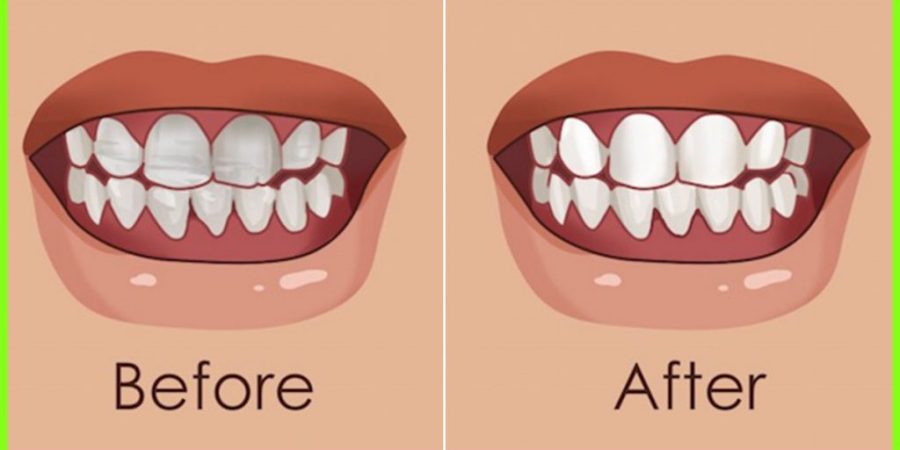 Strengthen You Teeth and Gums With This Natural Home Remedies