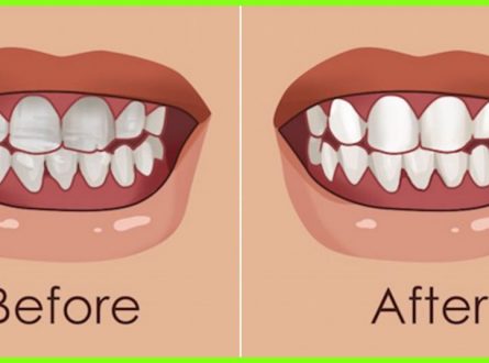 Strengthen You Teeth and Gums With This Natural Home Remedies