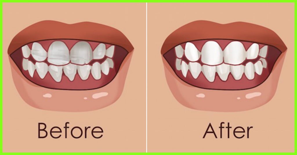 Strengthen You Teeth and Gums With This Natural Home Remedies