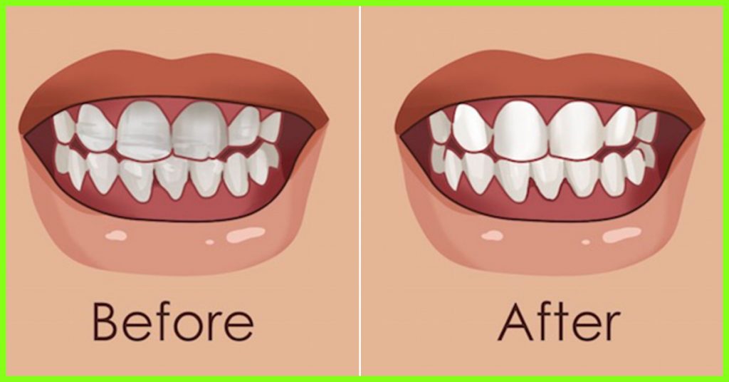 strengthen-you-teeth-and-gums-with-this-natural-home-remedies