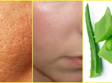 How To Get Rid of a Large Open Pores With Natural Home Remedies