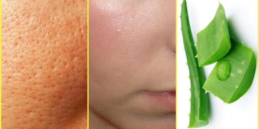 How To Get Rid of a Large Open Pores With Natural Home Remedies