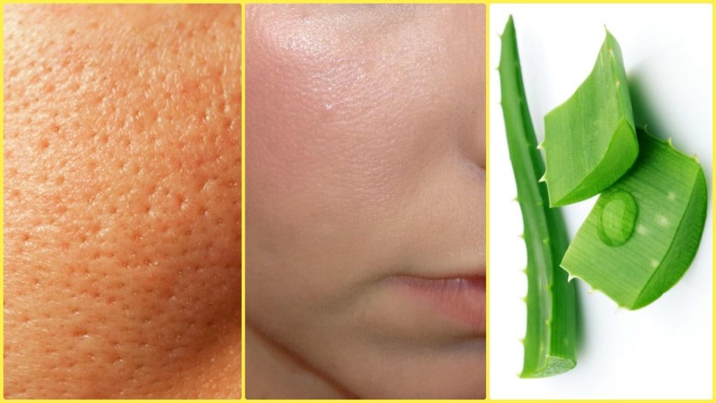How To Get Rid of a Large Open Pores With Natural Home Remedies