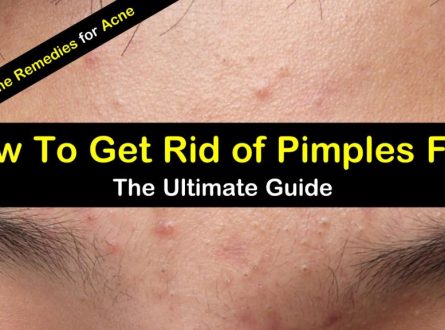 How To Get Rid Of Acne - Acne Treatment