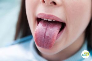 Home Remedies to Get Rid of Burning Mouth