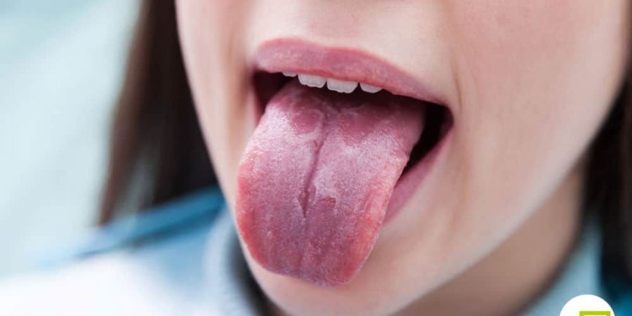 Home Remedies to Get Rid of Burning Mouth