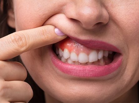 How To Reduce Gum Swelling With Home Remedies