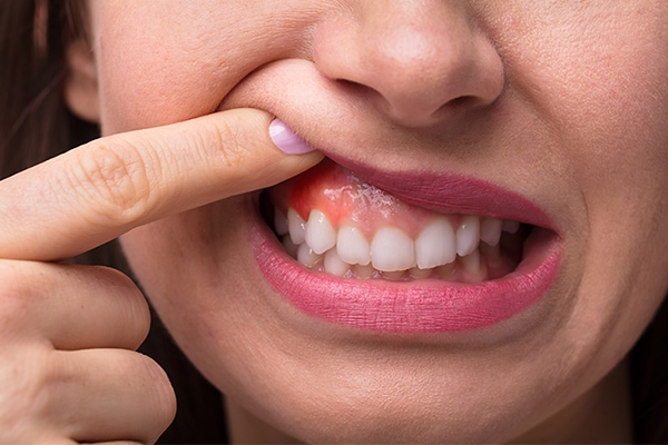 How To Reduce Gum Swelling With Home Remedies