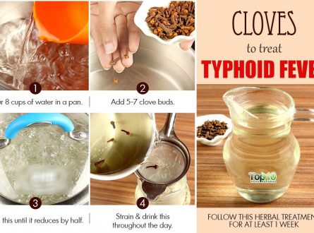 Home Remedies for Typhoid Fever