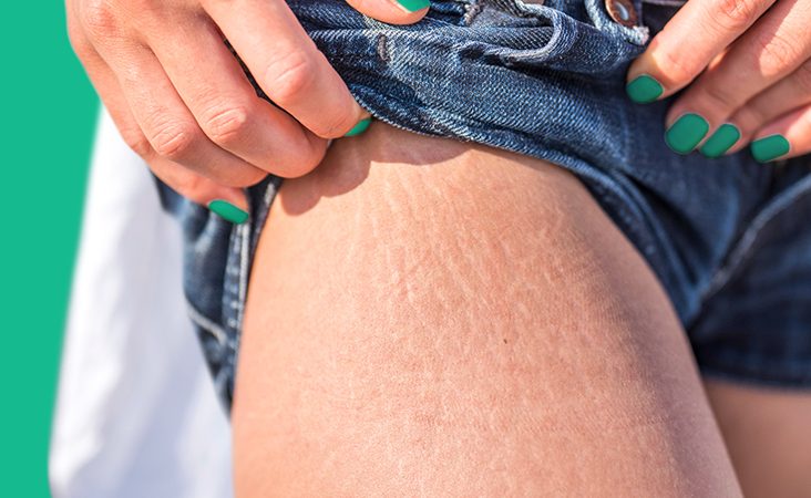 NATURAL HOME REMEDIES TO GET RID OF STRETCHMARKS